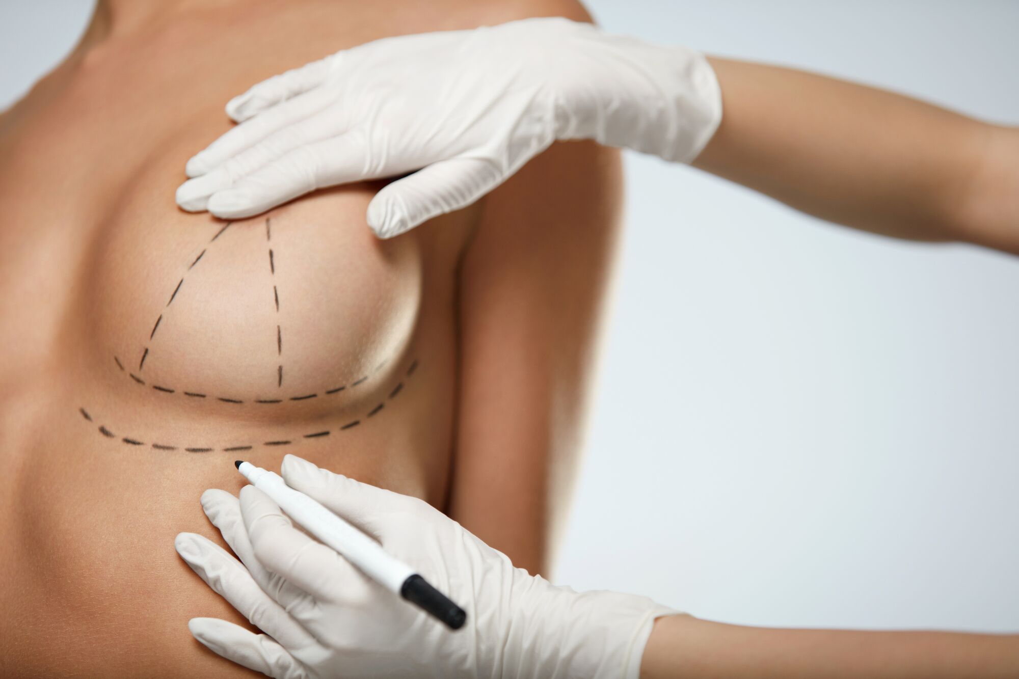 Breast Lift (Mastopexy): Surgery & Recovery